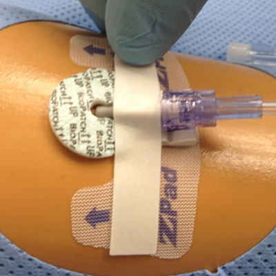 catheter